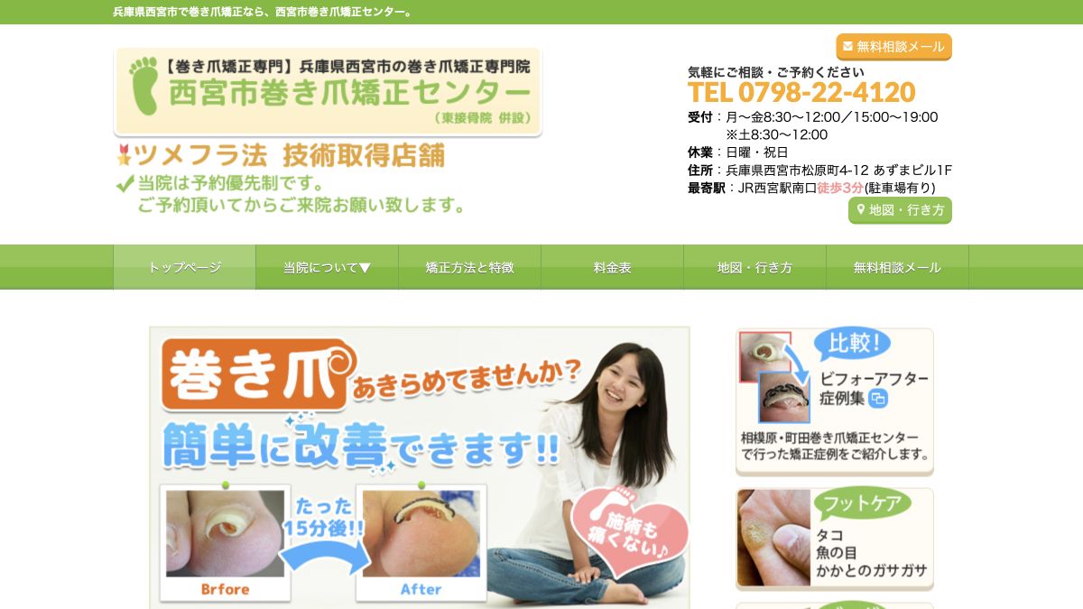 西宮市巻き爪矯正センター公式サイトのサービス案内